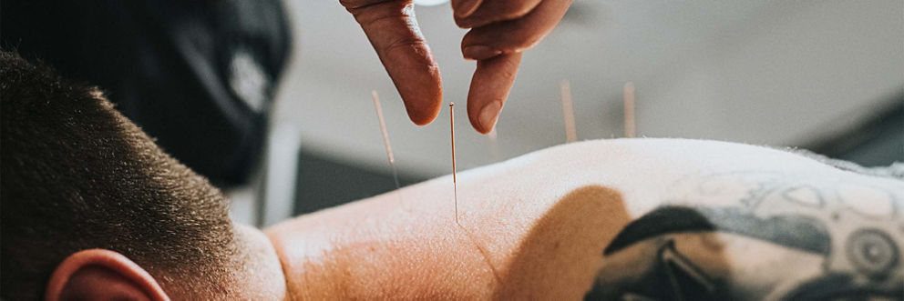 A physical therapist places acupuncture needles in a patient's back.