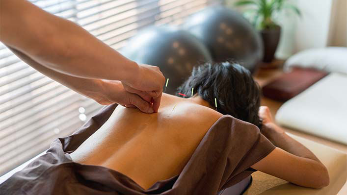 A woman undergoes an acupuncture treatment on her back.