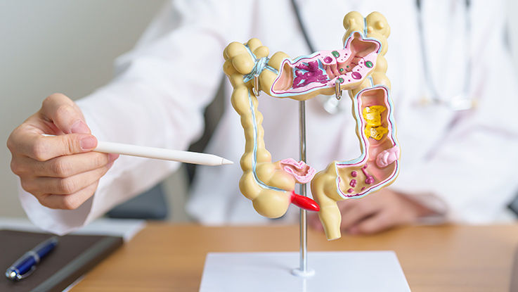 A doctor uses a medical model to point out the location of a condition that needs colorectal surgery